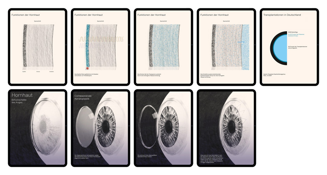 cornea transplantation