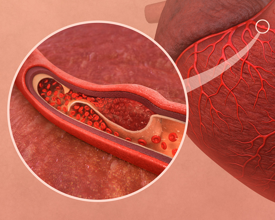 close-up of artery with blood particles