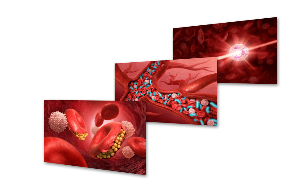 malaria